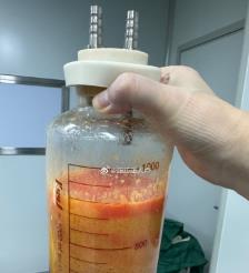 娄底水动力吸脂手术要做多久？